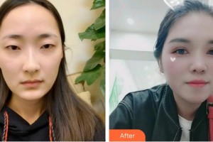 昭通愛麗諾醫(yī)療美容門診部吳鳳枝整形價格表附眼部綜合案例展示