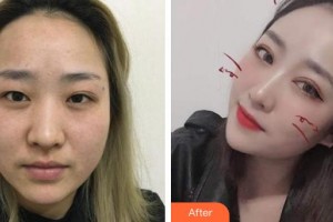 昭通愛麗諾醫(yī)療美容門診部段姍姍整形價(jià)格表附切開雙眼皮案例展示