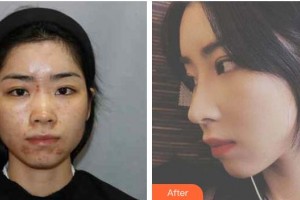 昭通瑪麗婦產醫(yī)院整形美容科李廷勛整形價格表附鼻部綜合案例展示