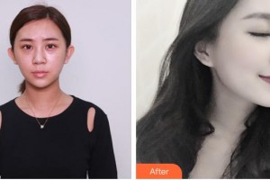 昭通瑪麗婦產醫(yī)院整形美容科曺秀沇整形價格表附膨體隆鼻案例展示