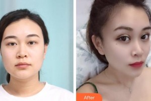 臨滄光明眼科醫(yī)院彭展輝整形價格表附外切祛眼袋案例展示