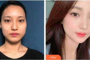 臨滄光明眼科醫(yī)院楊得勝整形價格表附切開雙眼皮案例展示