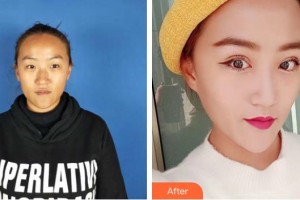 臨滄光明眼科醫(yī)院廖晴國整形價格表附切開雙眼皮案例展示