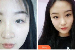 河南省立眼科醫(yī)院祝磊整形價格表附眼部綜合案例展示