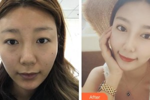 河北現(xiàn)代女子醫(yī)院整形美容中心趙國輝整形價(jià)格表附切開雙眼皮案例展示