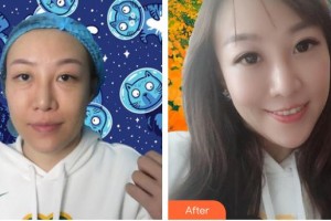 河北醫(yī)科大學(xué)第一醫(yī)院燒傷整形外科齊順貞整形價(jià)格表附激光去眼袋案例展示