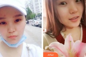 河北醫(yī)科大學(xué)第二醫(yī)院整形美容科張錘整形價(jià)格表附開內(nèi)眼角案例展示