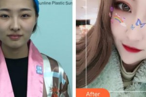 河北醫(yī)科大學(xué)第一醫(yī)院燒傷整形外科張慶富整形價(jià)格表附切開雙眼皮案例展示