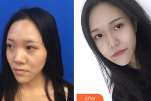 河北省中醫(yī)院醫(yī)療美容科四國軍整形價(jià)格表附鼻部綜合案例展示