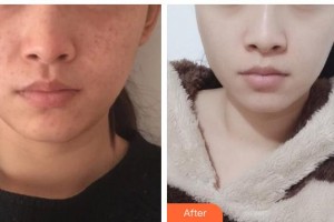 石家莊市中心醫(yī)院整形美容科支蕾整形價(jià)格表附激光祛斑案例展示