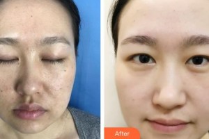 石家莊雅芳亞醫(yī)療美容醫(yī)院王文明整形價(jià)格表附微針?biāo)獍咐故?>
</a>
<h3 class=