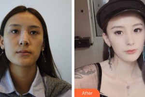 石家莊友誼燒傷醫(yī)院美容整形科李棟梁整形價(jià)格表附耳軟骨復(fù)合隆鼻案例展示