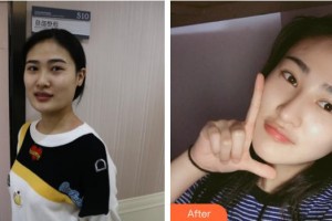 石家莊星源美天醫(yī)療美容醫(yī)院田躍華整形價(jià)格表附鼻部綜合案例展示