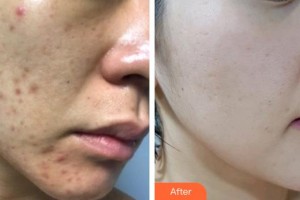 石家莊專家團醫(yī)院胎記色斑診療中心李亞輝整形價格表附光子嫩膚案例展示