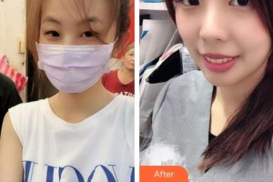 石家莊專家團醫(yī)院胎記色斑診療中心何小東整形價格表附激光祛斑案例展示