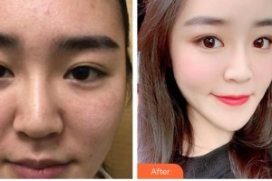 石家莊專家團醫(yī)院胎記色斑診療中心陳曉晨整形價格表附鐳射凈膚案例展示