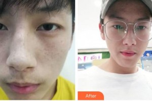 石家莊專家團醫(yī)院胎記色斑診療中心馬海霞整形價格表附祛斑祛痣案例展示