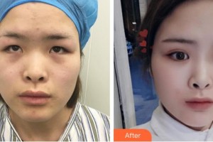 石家莊市第二醫(yī)院整形美容科史振鐸整形價格表附眼部綜合案例展示