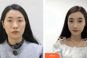 石家莊冀美醫(yī)療美容門診部陳良峰整形價格表附眼部綜合案例展示