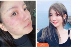 石家莊冀美醫(yī)療美容門診部張贏心整形價格表附光子嫩膚案例展示