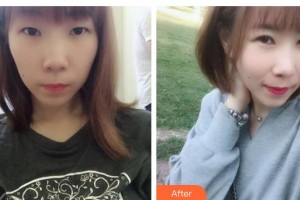 石家莊樂仁堂萬瑞醫(yī)療美容門診部李輝整形價格表附切開雙眼皮案例展示