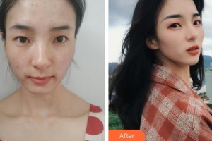 石家莊樂仁堂萬瑞醫(yī)療美容門診部曾明禮整形價格表附清潔祛痘案例展示