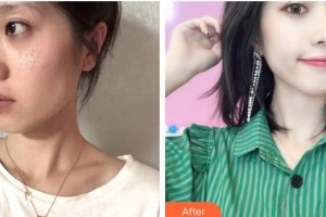 石家莊藍山醫(yī)療美容醫(yī)院王興奎整形價格表附激光祛斑案例展示