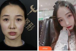 石家莊貴美人醫(yī)療美容醫(yī)院張冠勛整形價格表附肋軟骨隆鼻案例展示