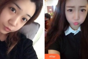 石家莊越然醫(yī)療美容門診部霍慧珍整形價格表附鼻部綜合案例展示