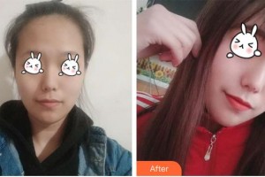 石家莊越然醫(yī)療美容門診部王寶琦整形價格表附光子嫩膚案例展示