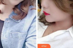 石家莊美萊醫(yī)學(xué)美容醫(yī)院田躍華整形價格表附激光祛斑案例展示