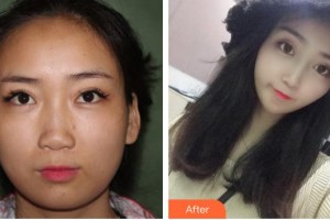 石家莊俏之翼醫(yī)療美容門診部金炫廷整形價格表附鼻部綜合案例展示