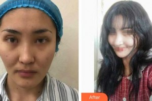 石家莊美萊醫(yī)學(xué)美容醫(yī)院張芳整形價格表附鼻部綜合案例展示