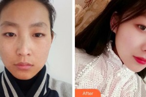 石家莊俏之翼醫(yī)療美容門診部樸智慧整形價格表附光子嫩膚案例展示