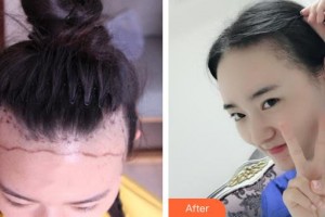 石家莊雍禾植發(fā)醫(yī)院馬曉陽整形價格表附植發(fā)案例展示