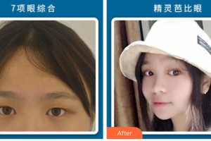 石家莊艾麥德醫(yī)療美容門診部王秀紅整形價(jià)格表附切開雙眼皮案例展示