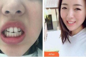 石家莊艾麥德醫(yī)療美容門診部張曉建整形價(jià)格表附隱形托槽矯正案例展示