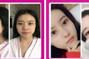 石家莊九朵醫(yī)療美容醫(yī)院沃貝貝整形價(jià)格表附切開(kāi)雙眼皮案例展示