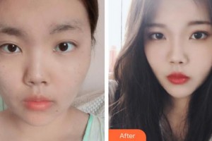 石家莊倩仕醫(yī)療整形美容門(mén)診部李娟整形價(jià)格表附光子嫩膚案例展示