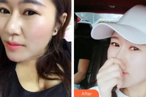 石家莊市婦產(chǎn)醫(yī)院醫(yī)療整形美容科高慧整形價(jià)格表附清潔祛痘案例展示