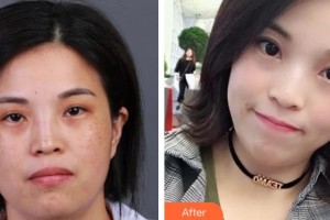 石家莊匯美天成醫(yī)療美容門(mén)診部王麗整形價(jià)格表附激光祛斑案例展示