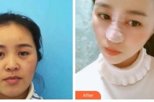 石家莊匯美天成醫(yī)療美容門(mén)診部翟彥剛整形價(jià)格表附鼻部綜合案例展示