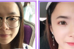 石家莊康體醫(yī)療美容門(mén)診部孫衛(wèi)海整形價(jià)格表附埋線雙眼皮案例展示