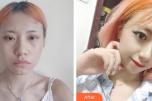 唐山惠美登醫(yī)療美容醫(yī)院劉彤整形價(jià)格表附激光祛疤案例展示