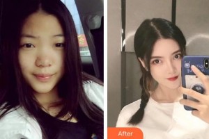 唐山煤醫(yī)整形美容醫(yī)院金明徹整形價(jià)格表附鼻部綜合案例展示