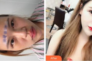 唐山煤醫(yī)整形美容醫(yī)院徐萬群整形價(jià)格表附假體隆鼻案例展示