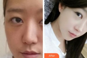 唐山開灤醫(yī)院整形美容中心趙紹明整形價(jià)格表附鼻部綜合案例展示