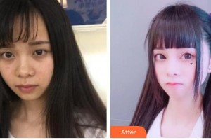 唐山煤醫(yī)整形美容醫(yī)院崔弘林整形價(jià)格表附切開雙眼皮案例展示