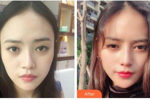 唐山煤醫(yī)整形美容醫(yī)院郭萬厚整形價(jià)格表附眼部綜合案例展示