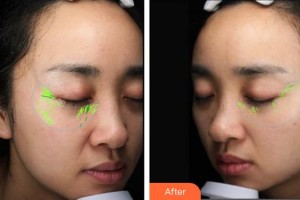 唐山星范醫(yī)療美容門(mén)診部劉俊偉整形價(jià)格表附埋線提升案例展示